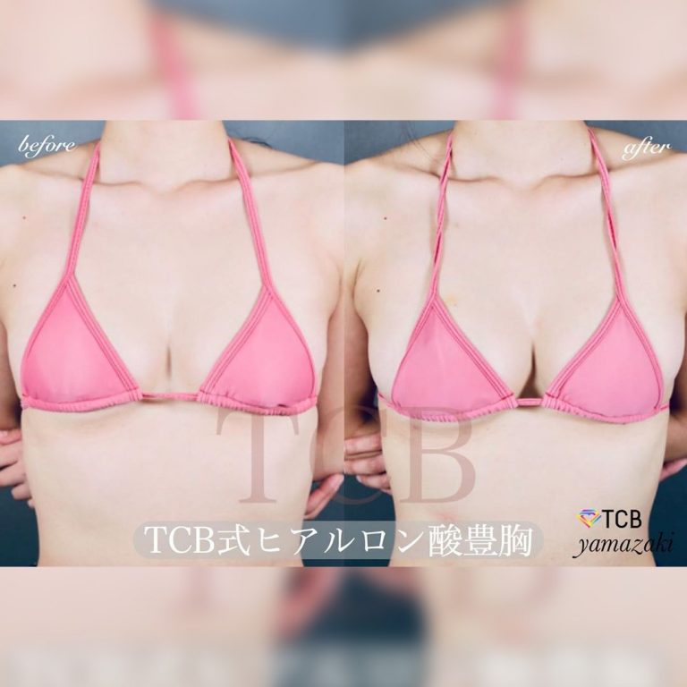 TCB式ヒアルロン酸豊胸(担当医:山崎 智徳 医師)の症例写真1
