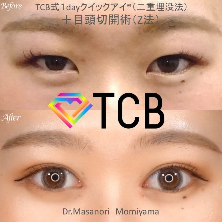 二重埋没法(担当医:樅山 真紀 医師)の症例写真1