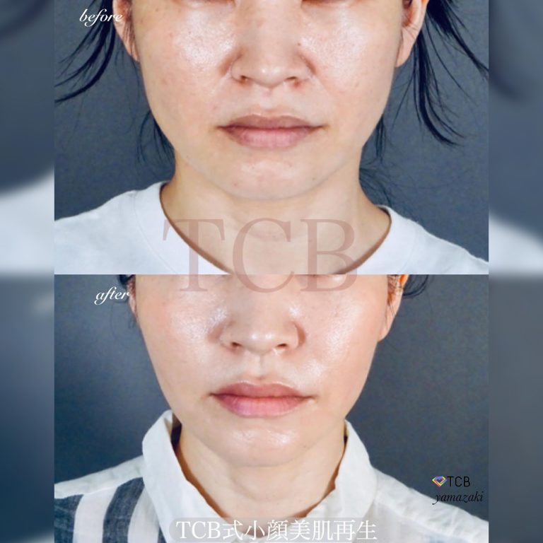 TCB式小顔美肌再生(担当医:山崎 智徳 医師)の症例写真1