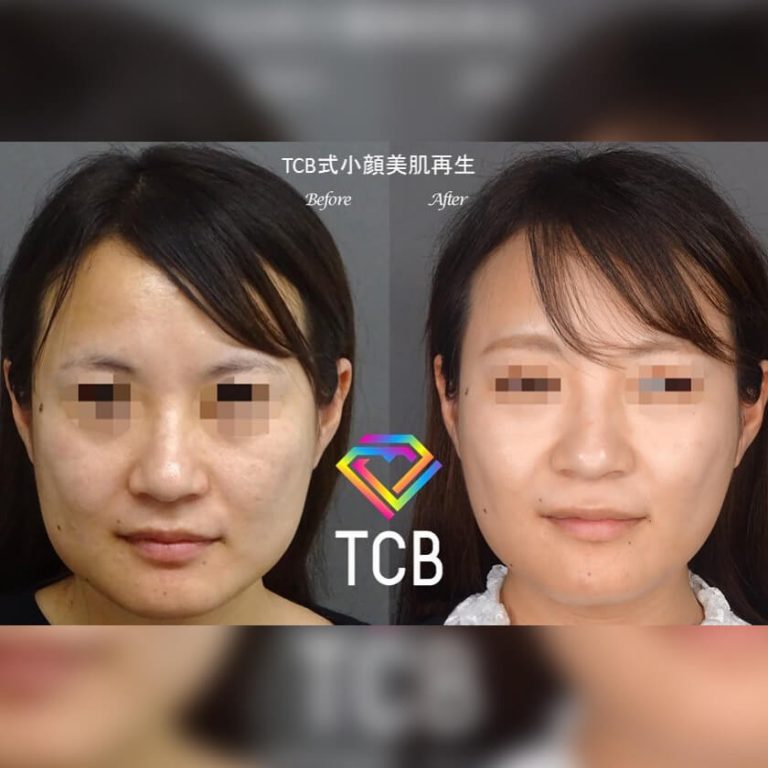 TCB式小顔美肌再生(担当医:樅山 真紀 医師)の症例写真1