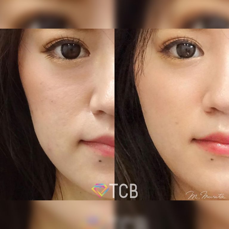 TCB式小顔美肌再生(担当医:村田 将光 医師)の症例写真1
