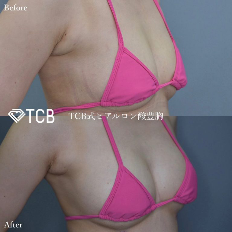 TCB式ヒアルロン酸豊胸(担当医:TCB 医師)の症例写真1