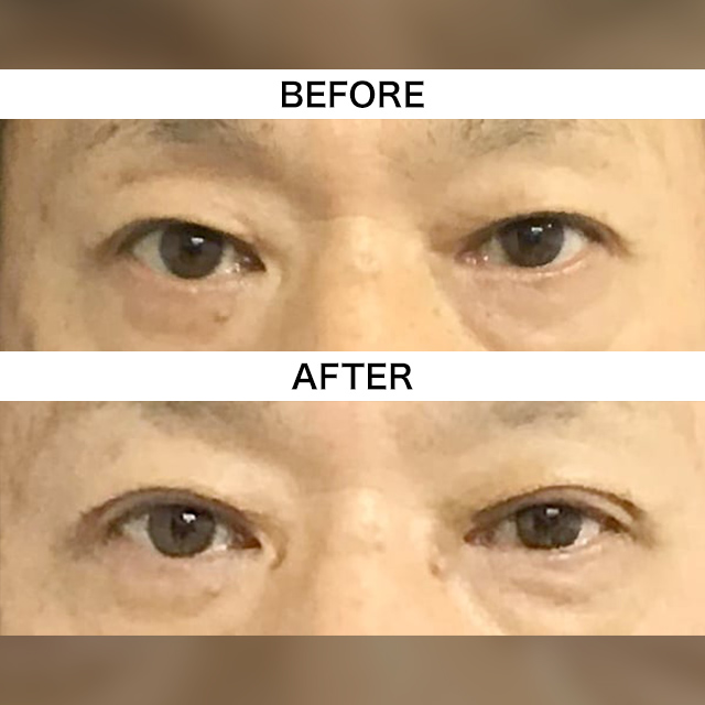 目の上のたるみ取り（上眼瞼除皺術）(担当医:TCB 医師)の症例写真1