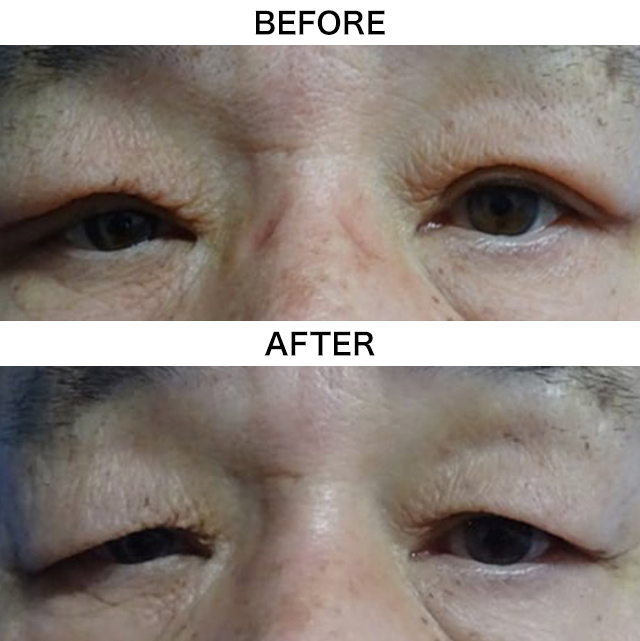 目の上のたるみ取り（上眼瞼除皺術）(担当医:TCB 医師)の症例写真1