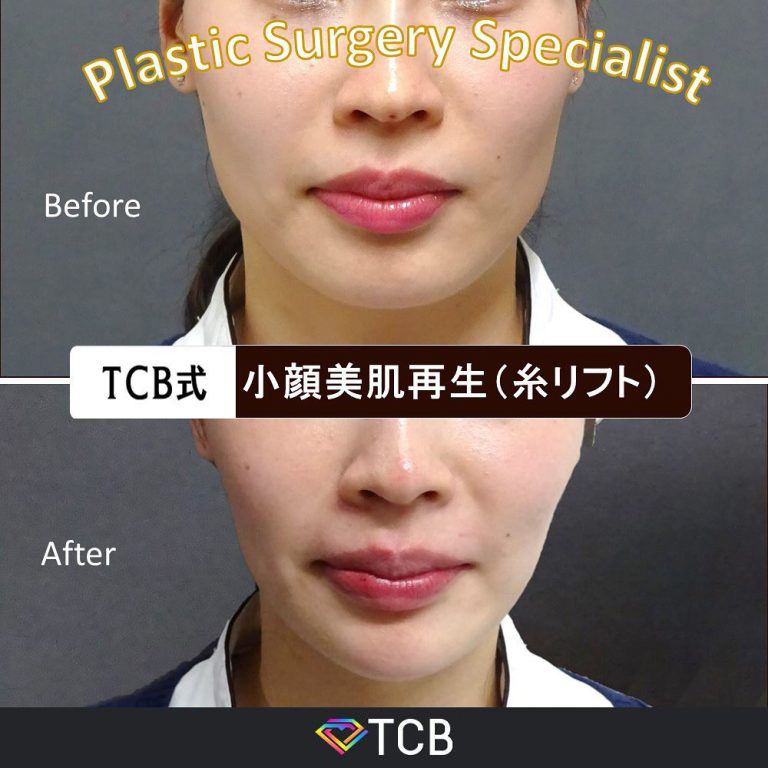 TCB式小顔美肌再生(担当医:TCB 医師)の症例写真1