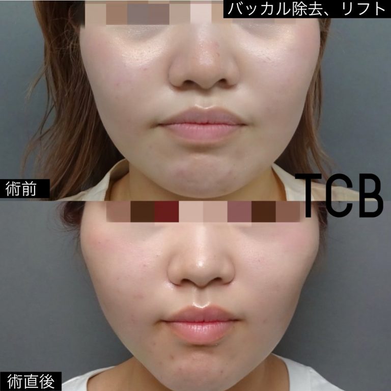 TCB式小顔美肌再生(担当医:今井 一臣 医師)の症例写真1