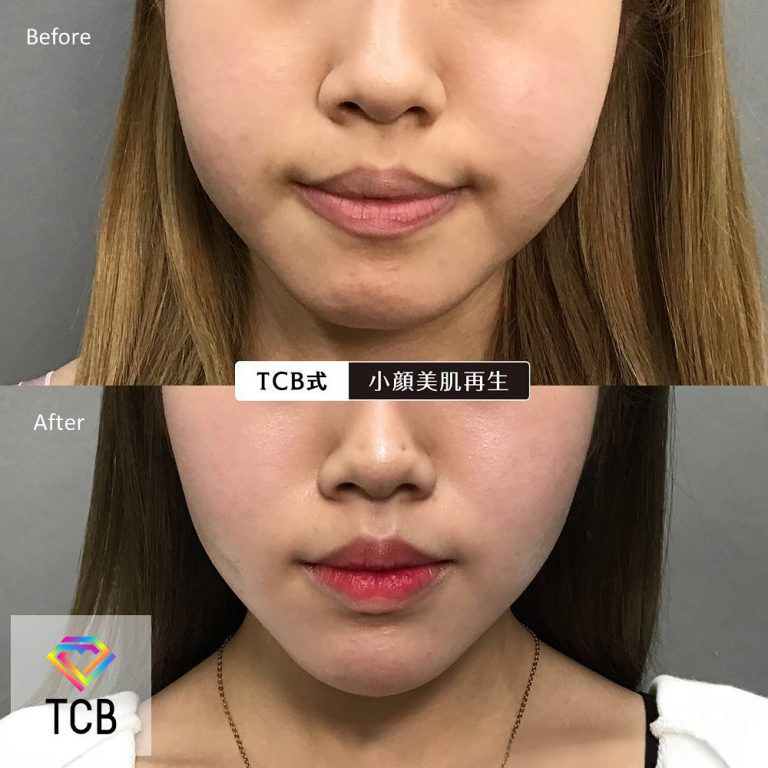 TCB式小顔美肌再生(担当医:TCB 医師)の症例写真1