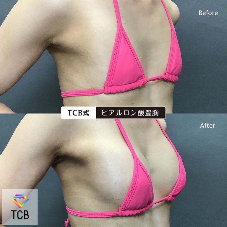 TCB式ヒアルロン酸豊胸(担当医:TCB 医師)の症例写真1