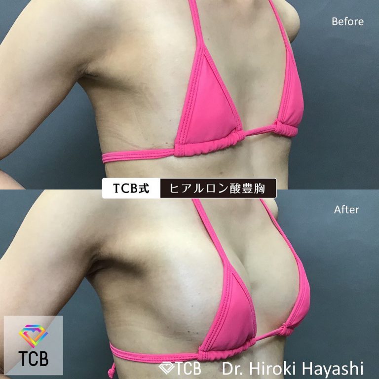 TCB式ヒアルロン酸豊胸(担当医:林 弘樹 医師)の症例写真1