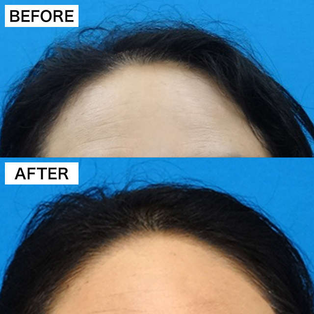 FAGA治療（女性の薄毛治療）(担当医:TCB 医師)の症例写真1
