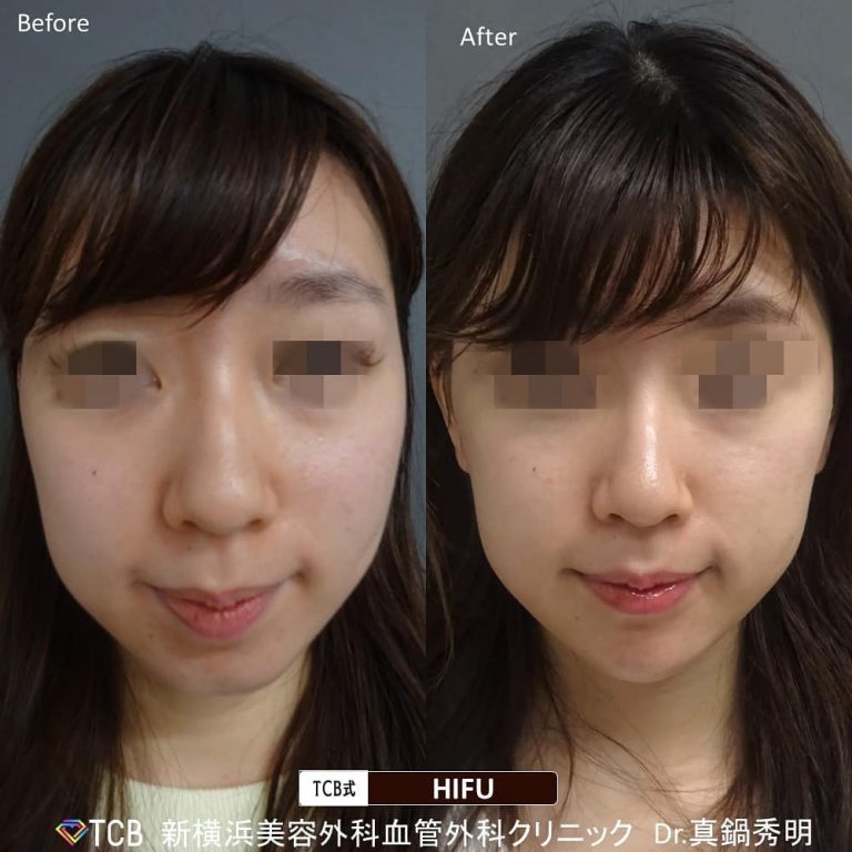 症例写真（医療ハイフ（HIFU）） | 美容整形はTCB東京中央美容外科