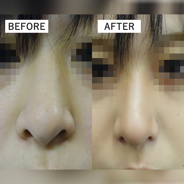 TCB式鼻翼縮小完全内側法(担当医:TCB 医師)の症例写真1
