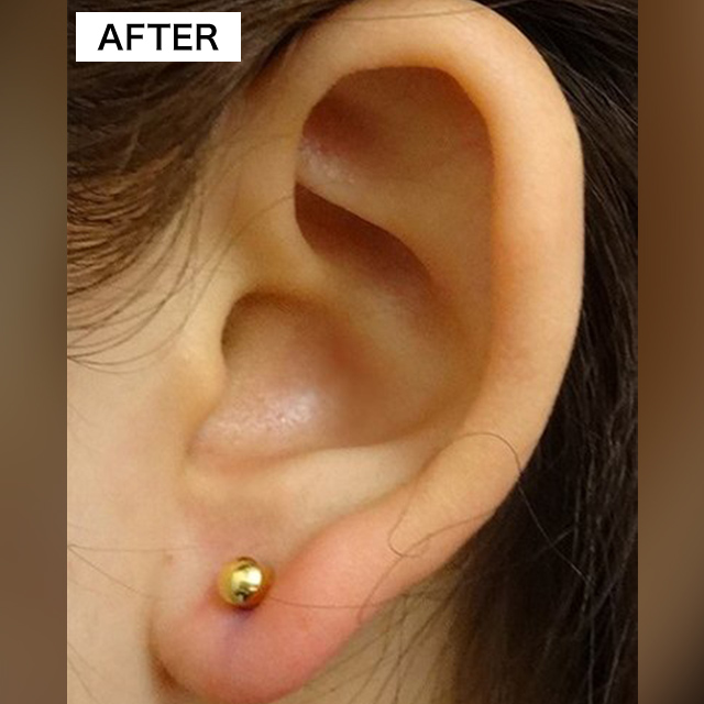 耳・へそのピアス穴開け整形(担当医:TCB 医師)の症例写真1