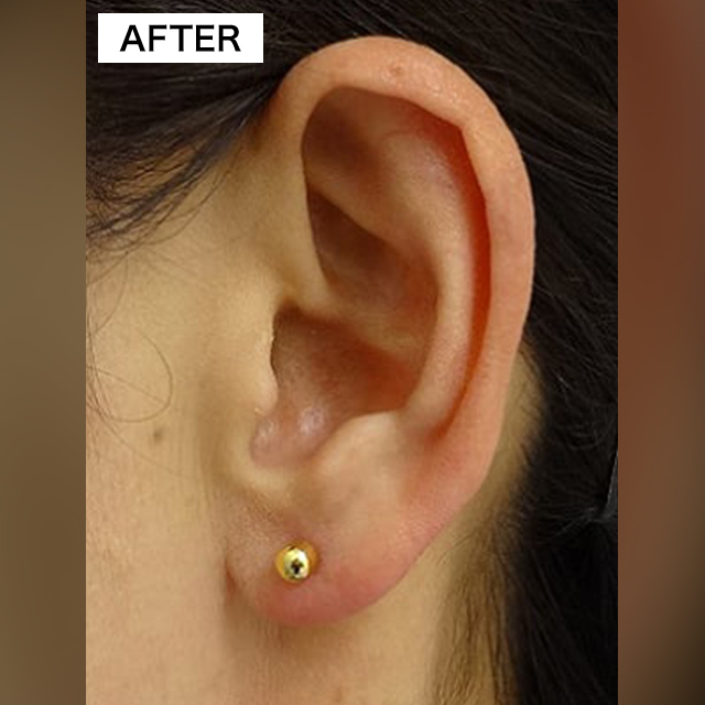 耳・へそのピアス穴開け整形(担当医:TCB 医師)の症例写真1