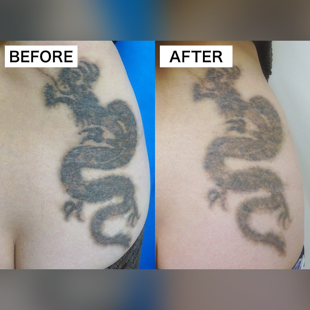 タトゥー除去(担当医:TCB 医師)の症例写真1