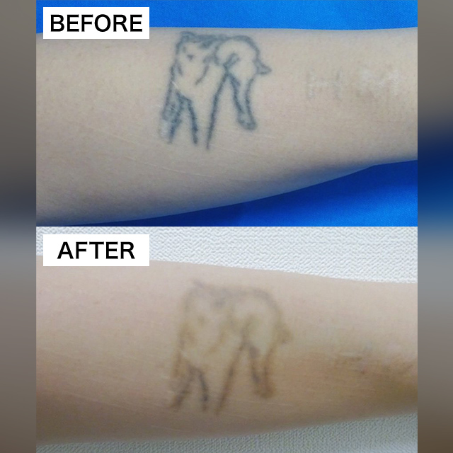タトゥー除去(担当医:TCB 医師)の症例写真1
