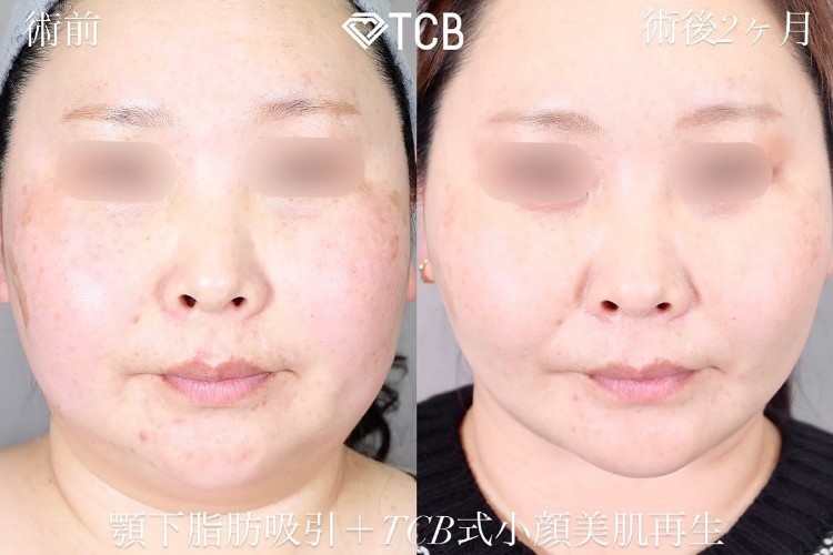 TCB式小顔脂肪吸引(担当医:TCB 医師)の症例写真1
