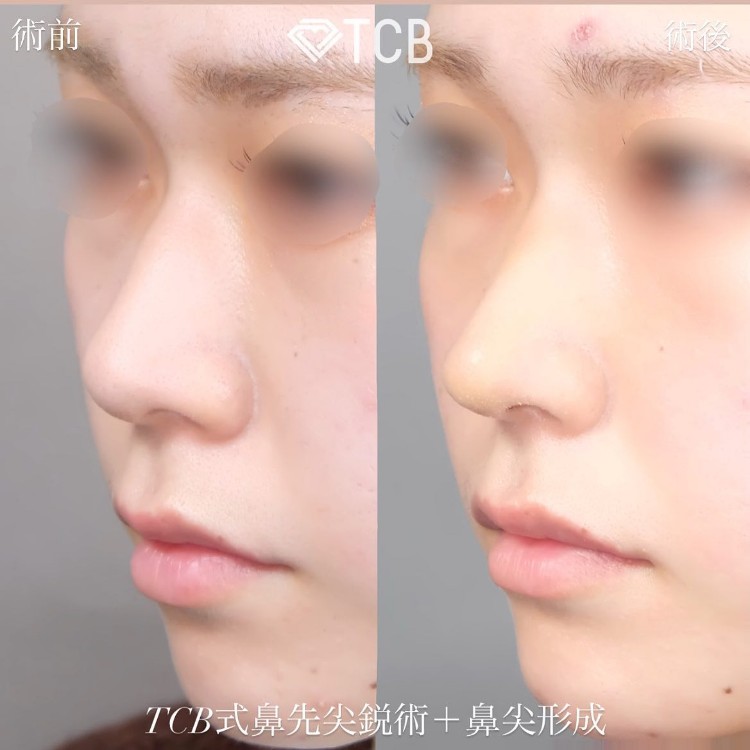 TCB式鼻先尖鋭術（だんご鼻解消）(担当医:TCB 医師)の症例写真1