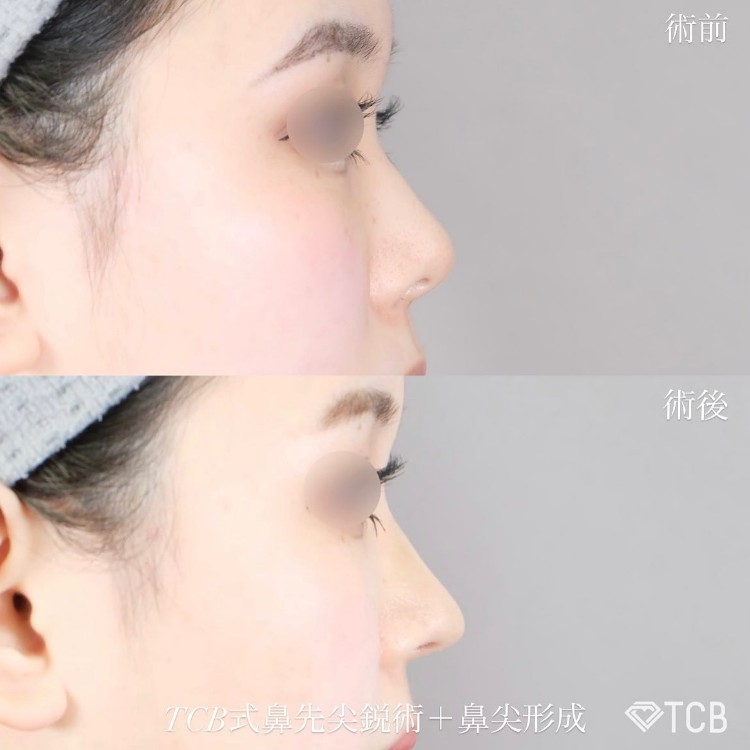 TCB式鼻先尖鋭術（だんご鼻解消）(担当医:TCB 医師)の症例写真1