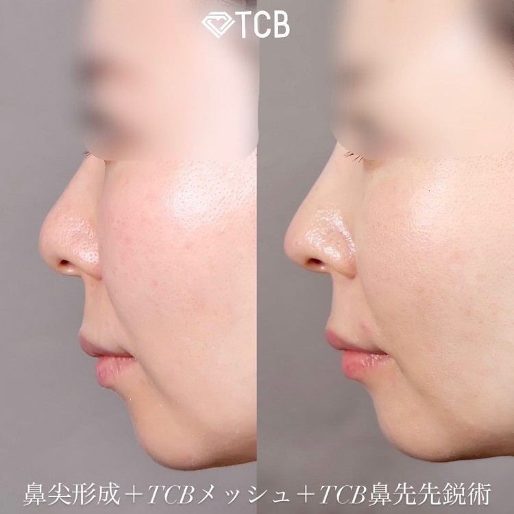 鼻尖形成(担当医:TCB 医師)の症例写真1