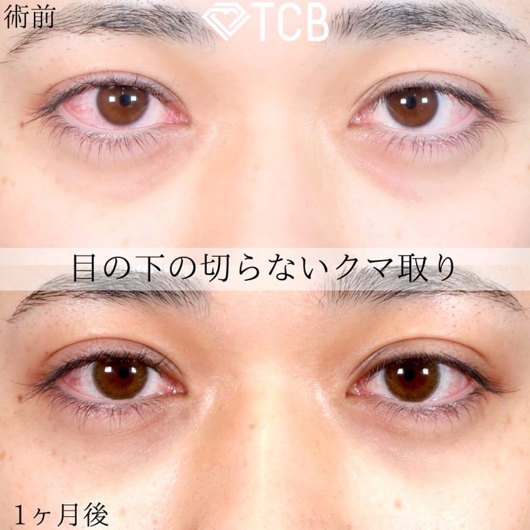 切らない目の下のクマ取り・目の下のたるみ（ふくらみ）取り(担当医:TCB 医師)の症例写真1