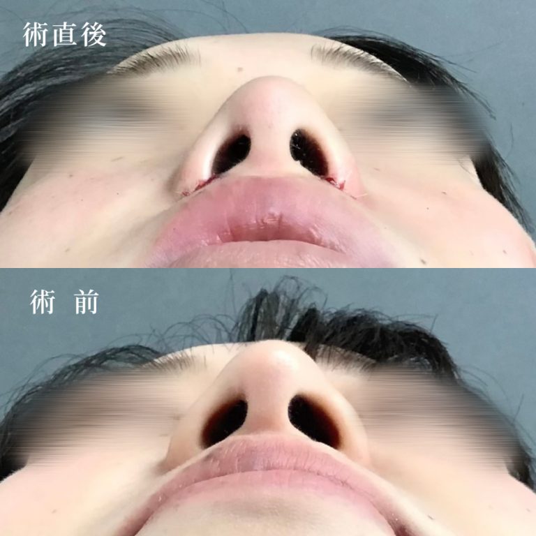 TCB式鼻翼縮小完全内側法(担当医:真鍋 秀明 医師)の症例写真1