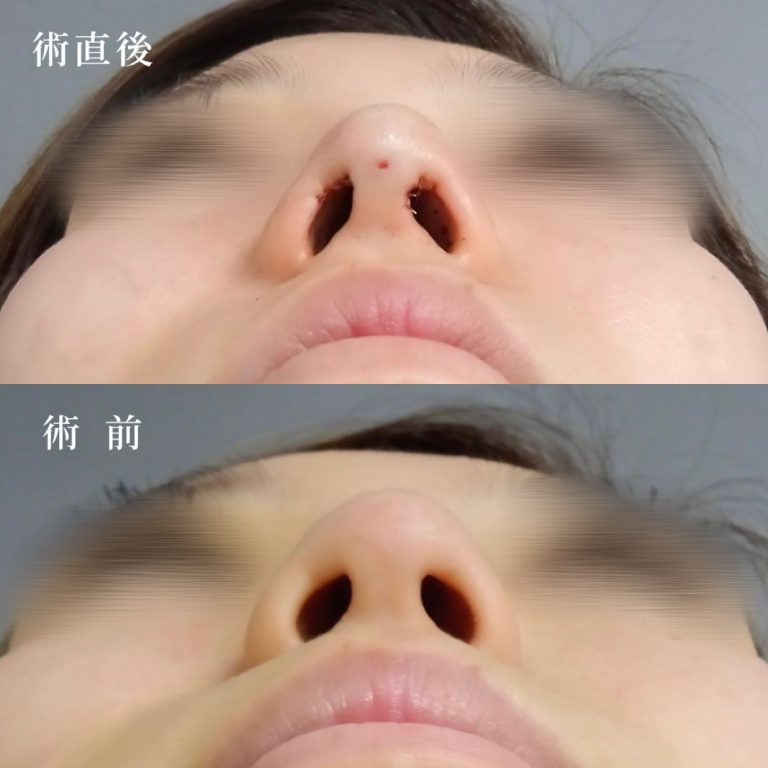 TCB式鼻先尖鋭術（だんご鼻解消）(担当医:真鍋 秀明 医師)の症例写真1
