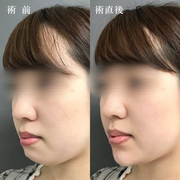 切らない顎形成 3D Eライン(担当医:真鍋 秀明 医師)の症例写真1