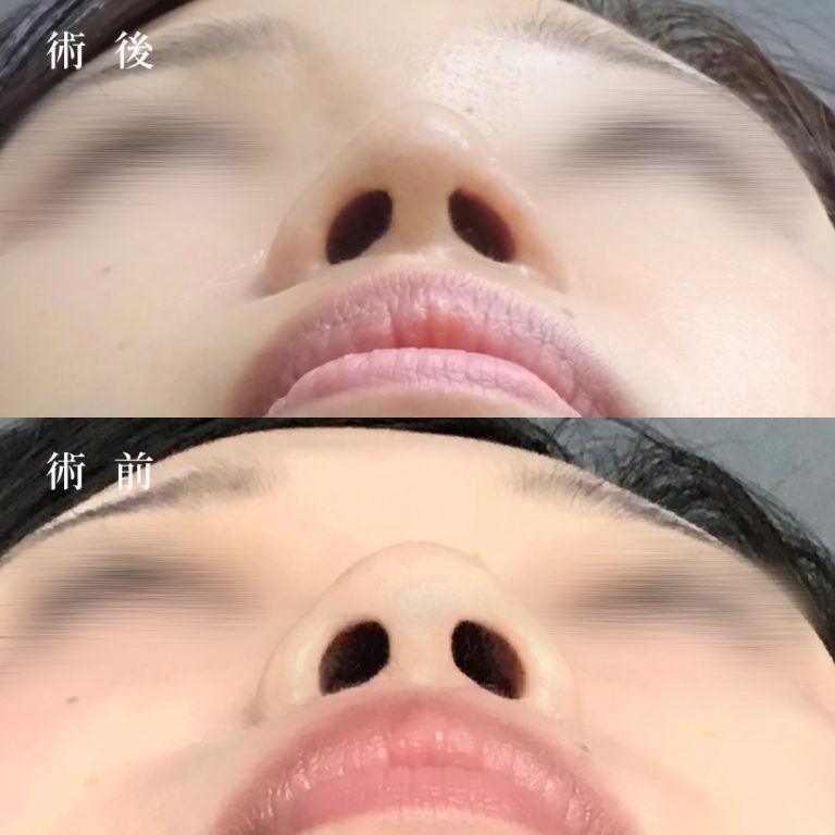 鼻尖形成(担当医:真鍋 秀明 医師)の症例写真1