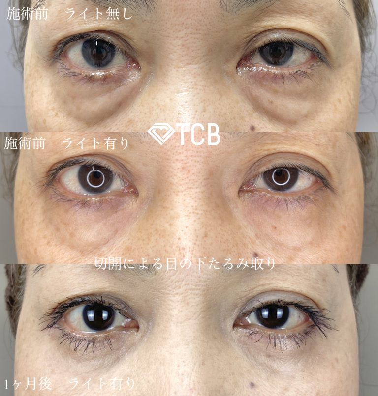 切開法による目の下のたるみ取り（下眼瞼除皺術）(担当医:佐藤 麻未 医師)の症例写真1