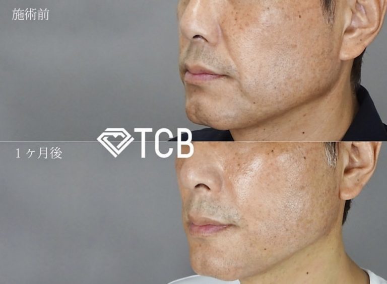 TCB式小顔美肌再生(担当医:寺西 宏王 医師)の症例写真2
