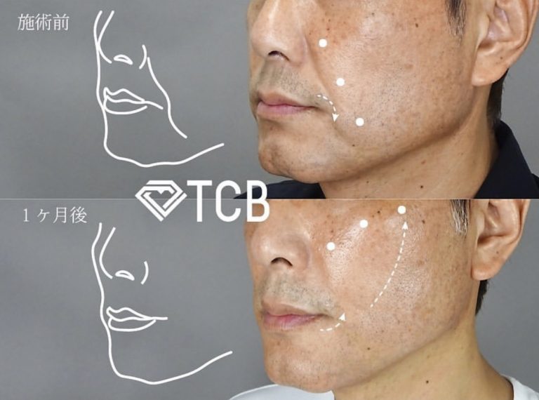 TCB式小顔美肌再生(担当医:寺西 宏王 医師)の症例写真1