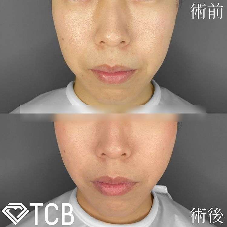 TCB小顔リフト(担当医:TCB 医師)の症例写真1