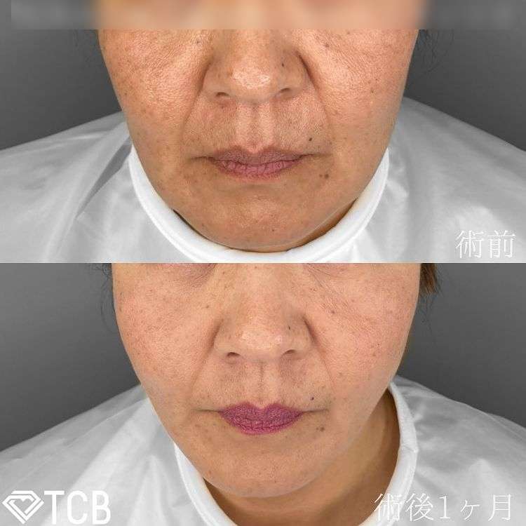 TCB小顔リフト(担当医:TCB 医師)の症例写真1