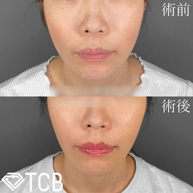 TCB小顔リフト(担当医:TCB 医師)の症例写真1