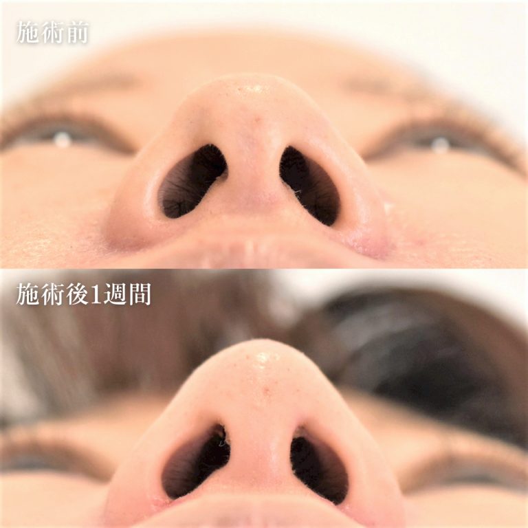 TCB式鼻翼縮小完全内側法(担当医:TCB 医師)の症例写真1