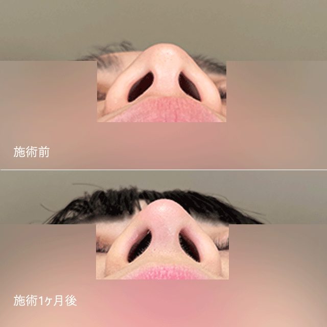 鼻尖形成(担当医:河村 宜生 医師)の症例写真2