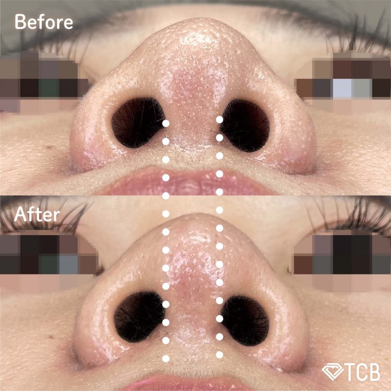切らない鼻中隔延長(担当医:TCB 医師)の症例写真2