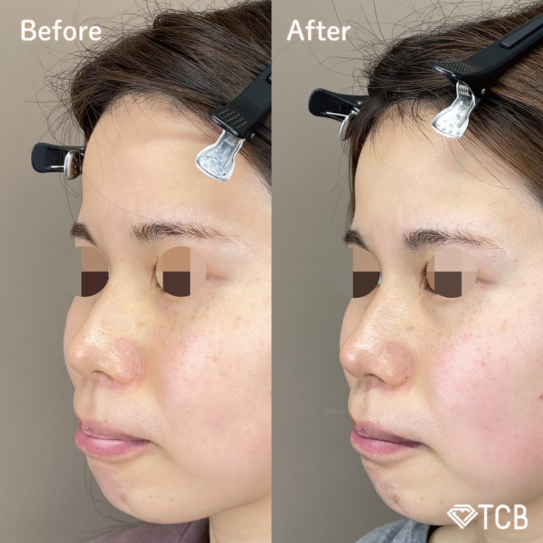 鼻尖形成完全閉鎖法（切らない鼻尖形成）(担当医:TCB 医師)の症例写真3