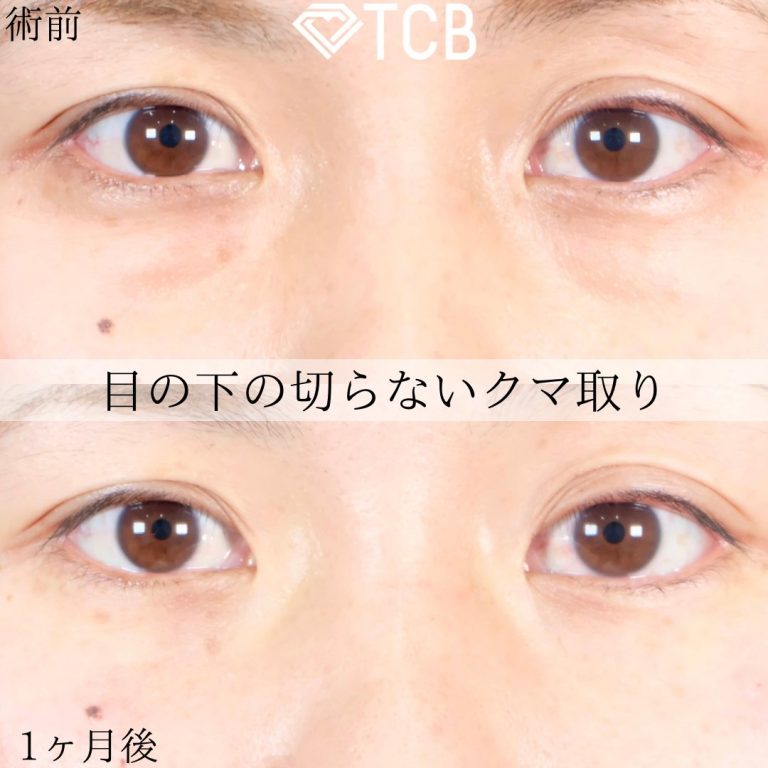切らない目の下のクマ取り・目の下のたるみ（ふくらみ）取り(担当医:TCB 医師)の症例写真1
