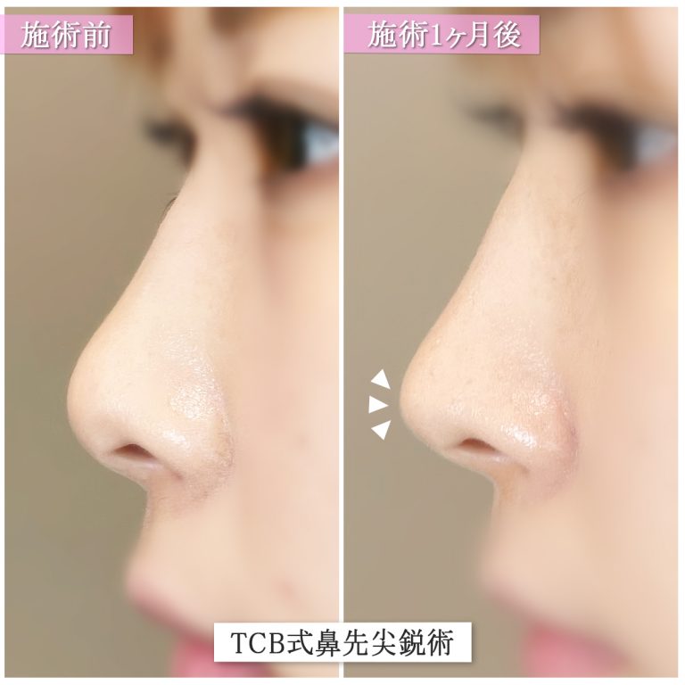 TCB式鼻先尖鋭術（だんご鼻解消）(担当医:篠永 宏行 医師)の症例写真1