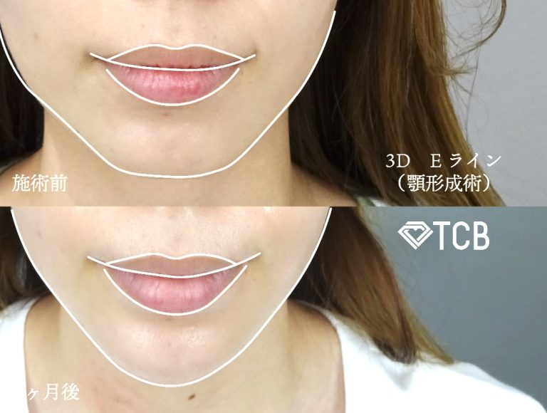 切らない顎形成 3D Eライン(担当医:寺西 宏王 医師)の症例写真1