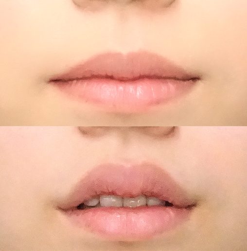 唇のヒアルロン酸注射(担当医:寺西 宏王 医師)の症例写真1