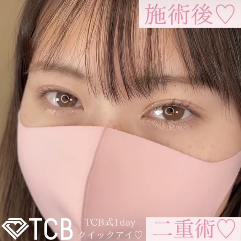 二重埋没法(担当医:TCB 医師)の症例写真1