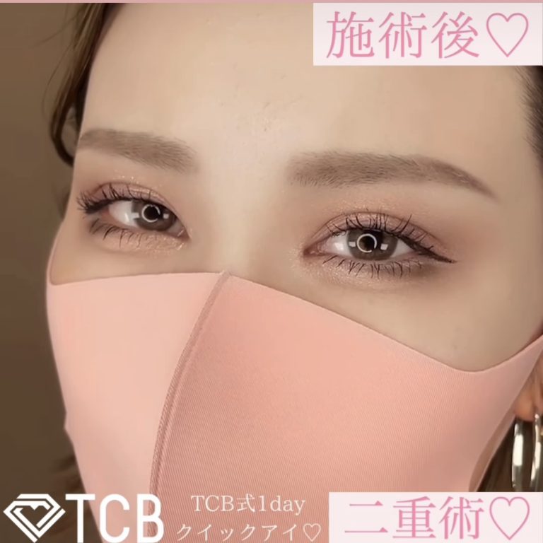 二重埋没法(担当医:TCB 医師)の症例写真1