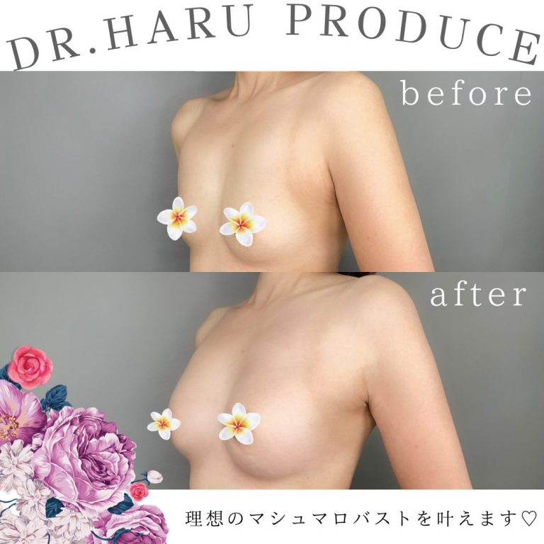 TCB式ヒアルロン酸豊胸(担当医:池田 悠 医師)の症例写真2