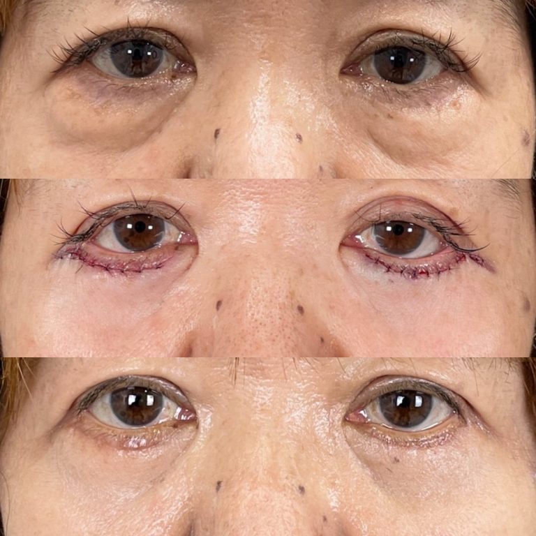 切開法による目の下のたるみ取り（下眼瞼除皺術）(担当医:TCB 医師)の症例写真2