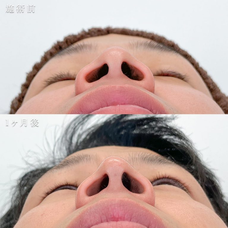 TCB式鼻先尖鋭術（だんご鼻解消）(担当医:TCB 医師)の症例写真2