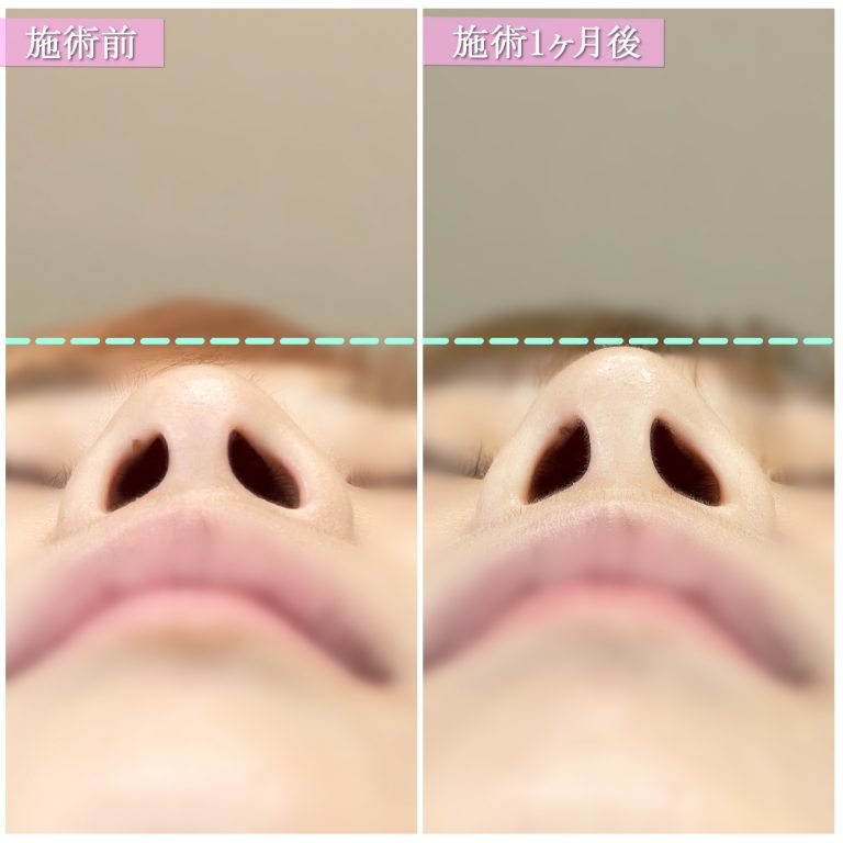 TCB式鼻先尖鋭術（だんご鼻解消）(担当医:篠永 宏行 医師)の症例写真2