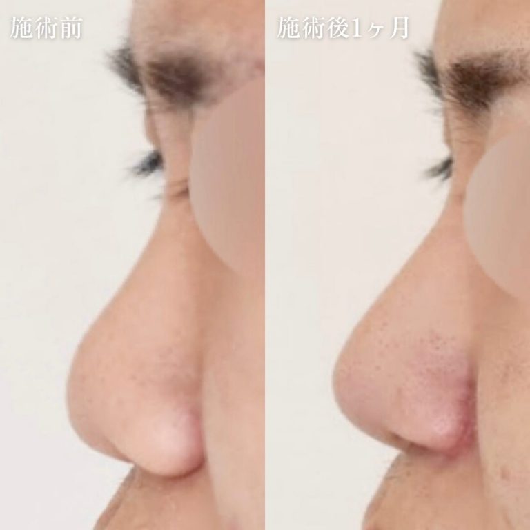 鼻プロテーゼ（隆鼻術）(担当医:TCB 医師)の症例写真1